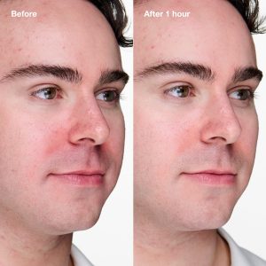 Acne Solutions Clinical? Advanced Clearing Gel